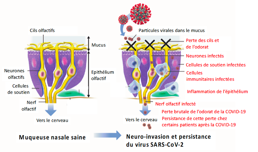Illustration muqueuse saine et muqueuse infectée au Sars-Cov2