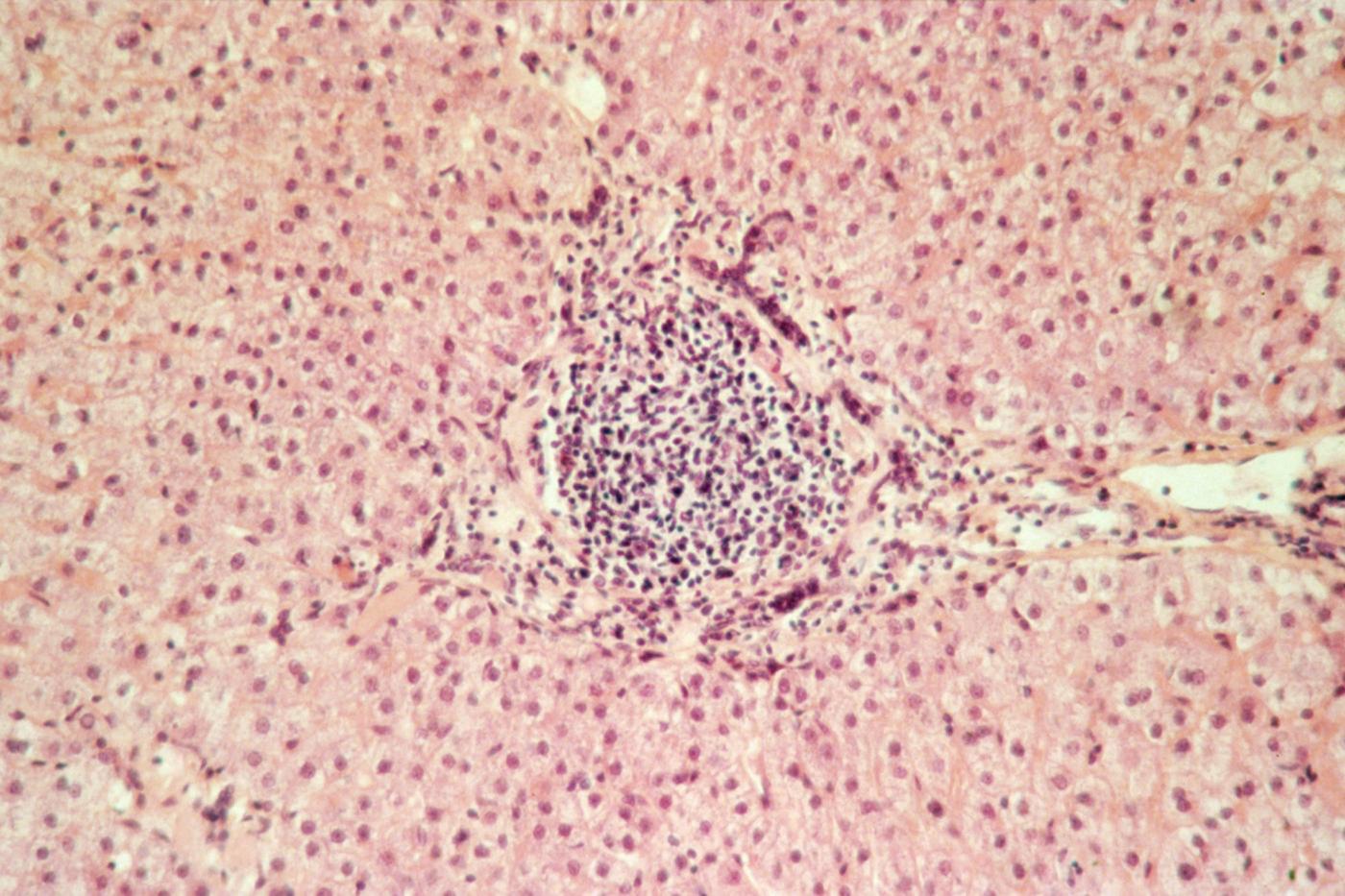 Coupe histologique foie - Hépatite C - Institut Pasteur