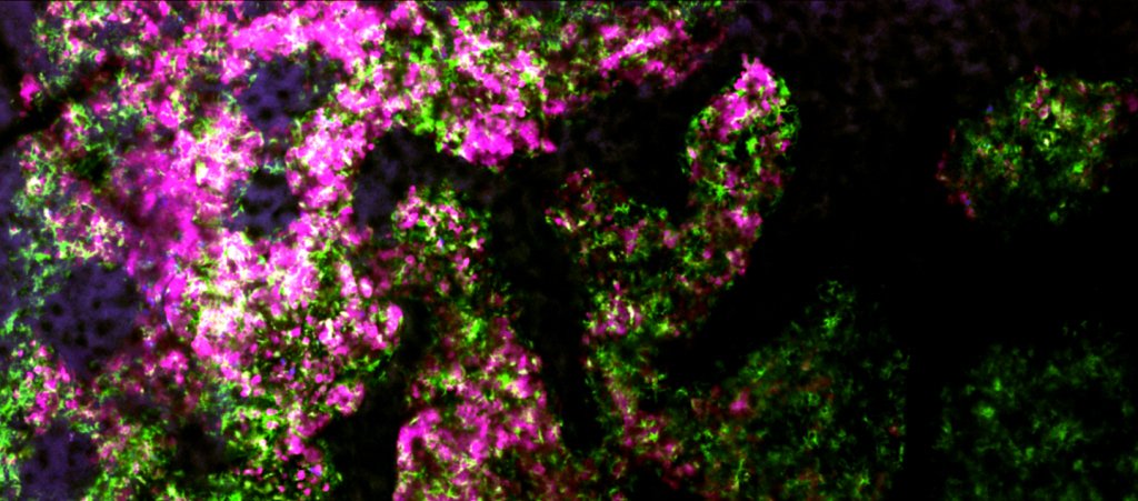 Cellules cancéreuses et macrophages s’attaquant aux cellules  tumorales © Institut Pasteur