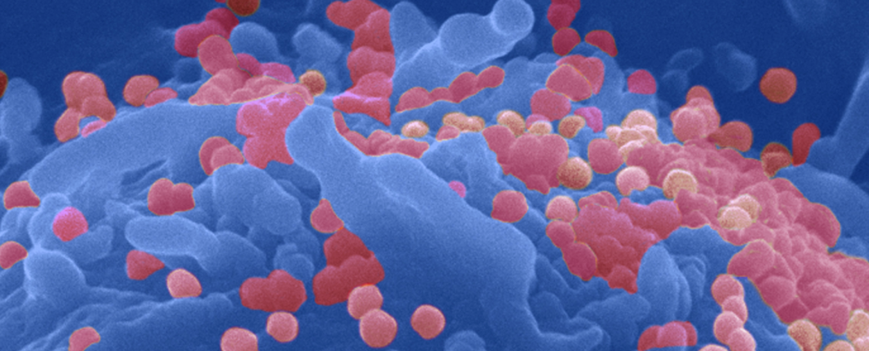 Sida : une piste vers l’élimination des réservoirs du VIH