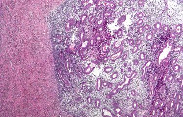Micrographie d'un ovaire endométriosique