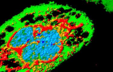 Cellule infectée par Zika (effet cytopathique), présentant de larges vacuoles (trous). En rouge : protéine virale. En vert : cellule. En bleu : noyau. Microscopie par immunofluorescence. 