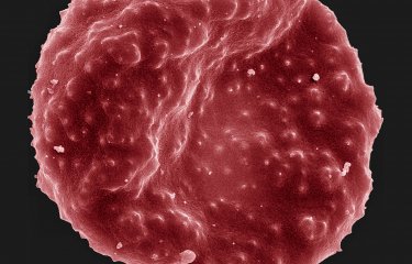  Globule rouge parasité par Plasmodium falciparum - Institut Pasteur