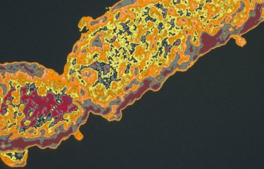 Fiches maladies - Coqueluche - Institut Pasteur