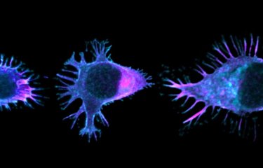 Cancer du côlon : comment la mutation du gène APC perturbe la migration des lymphocytes