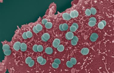 actéries Neisseria meningitidis adhérant à la surface de cellules épithéliales. Les diplocoques sont enchevêtrés dans des microvillosités d'origine cellulaires. 