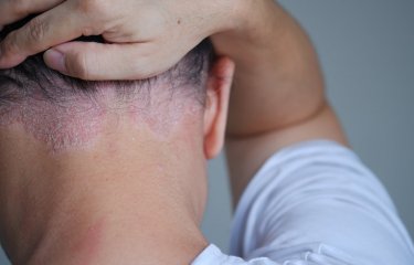 Institut Pasteur - psoriasis - prurit - pruritus