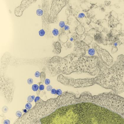 Lymphocyte T infecté par le Virus LAV (futur VIH) - Institut Pasteur